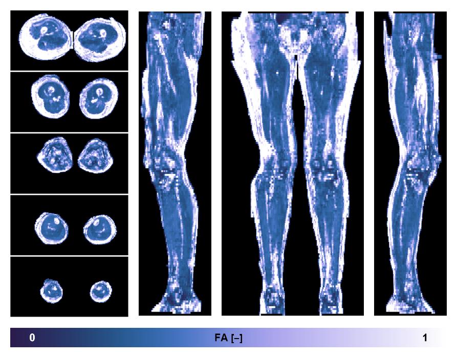 IVIM corrected whole leg muscle fractional anisotropy obtained from diffusion tensor imaging.